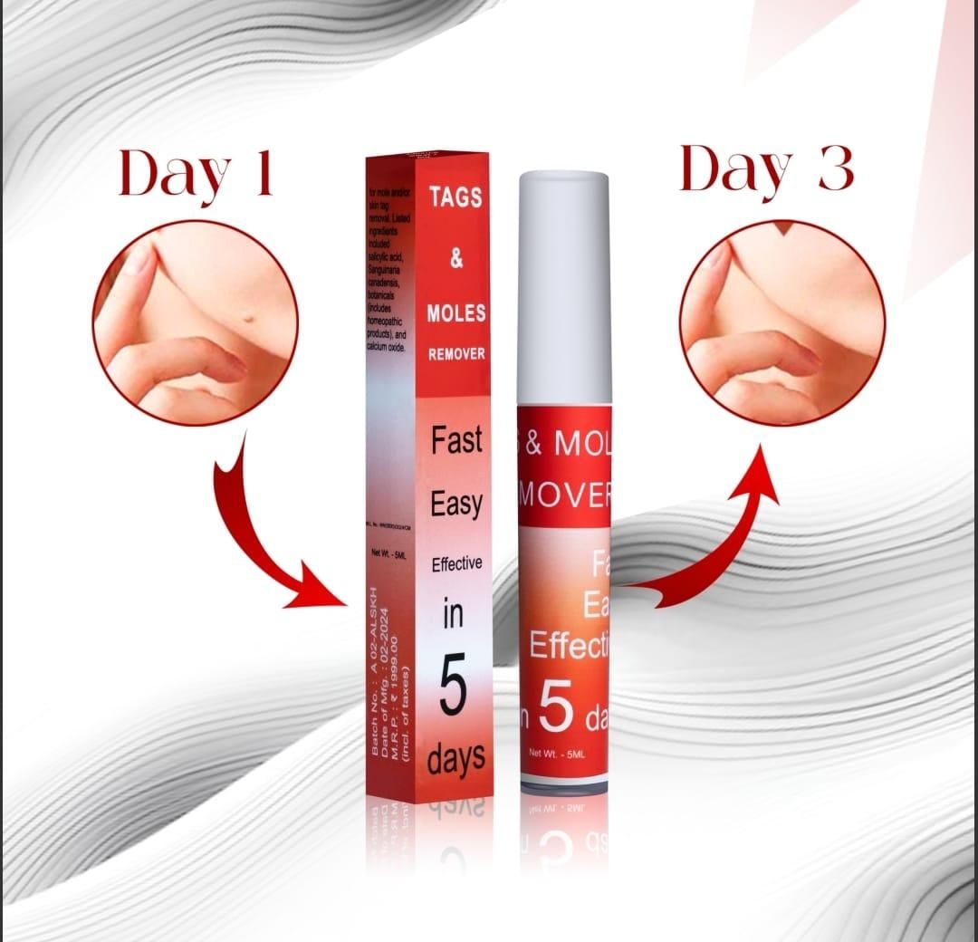 Tags & Moles Remover (BUY 1 GET 1 FREE) (98999+++Happy Customer ⭐⭐⭐⭐⭐)